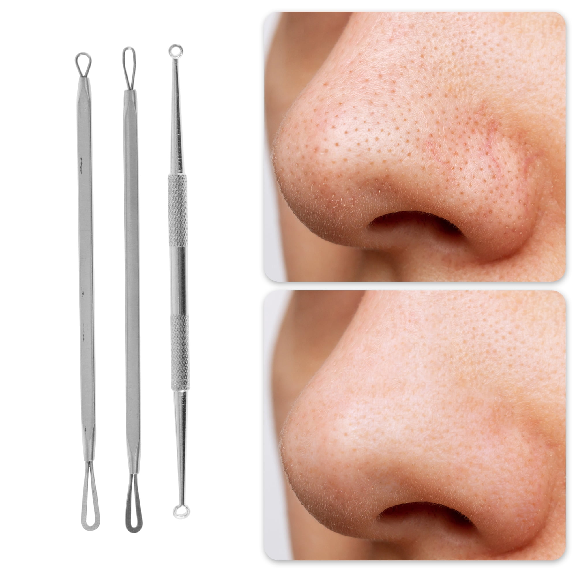 Professional Pimple Extractor  - Skincare Whitening ulasan dan harga